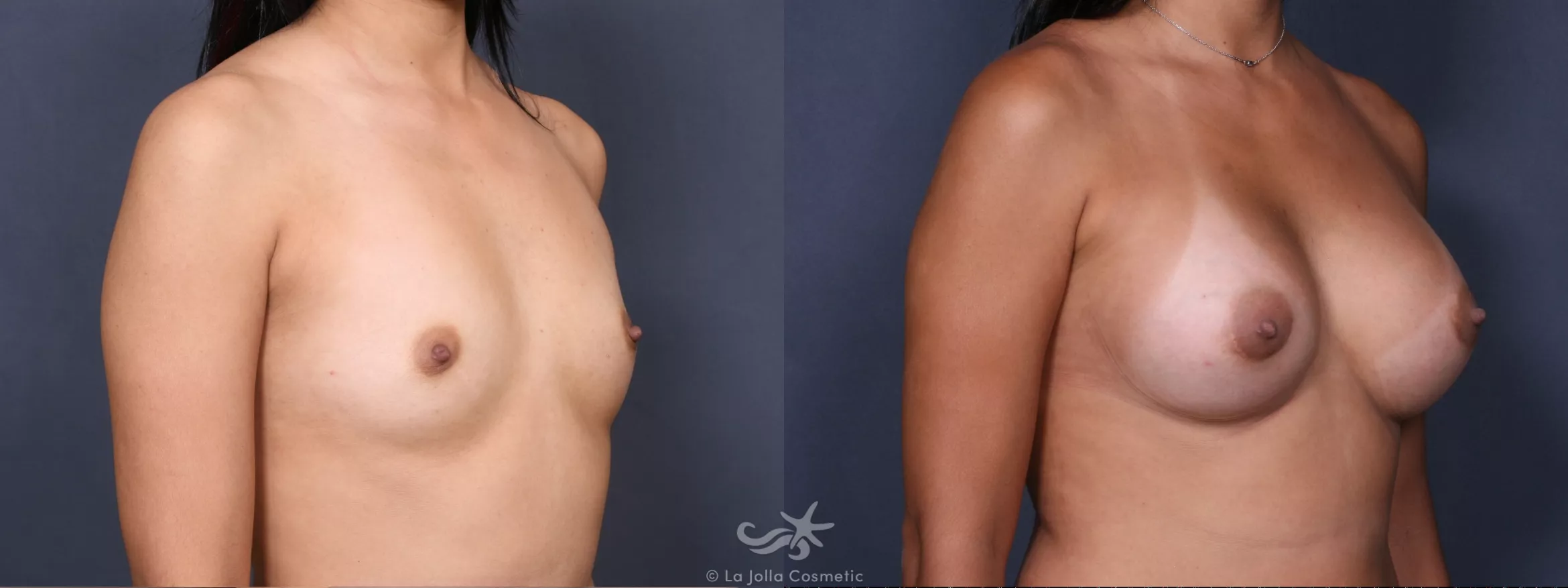 Before & After Breast Augmentation Result 394 Right Oblique View in San Diego, CA