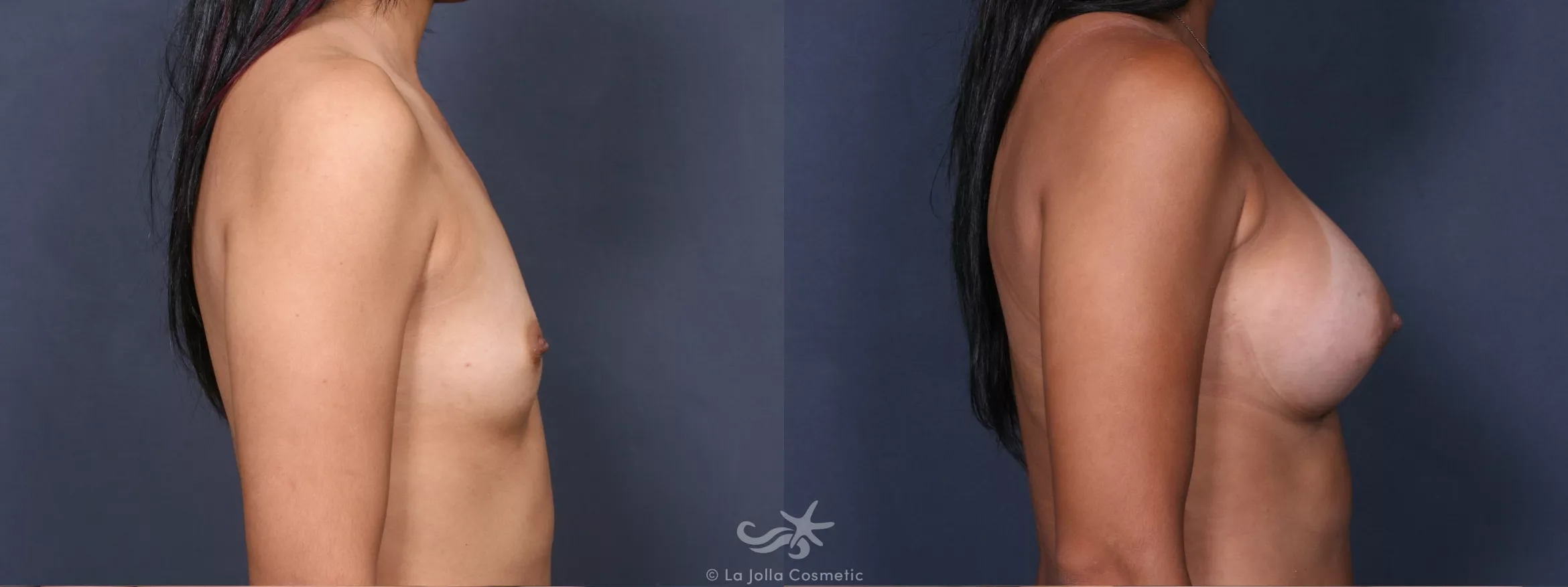 Before & After Breast Augmentation Result 394 Right Side View in San Diego, CA