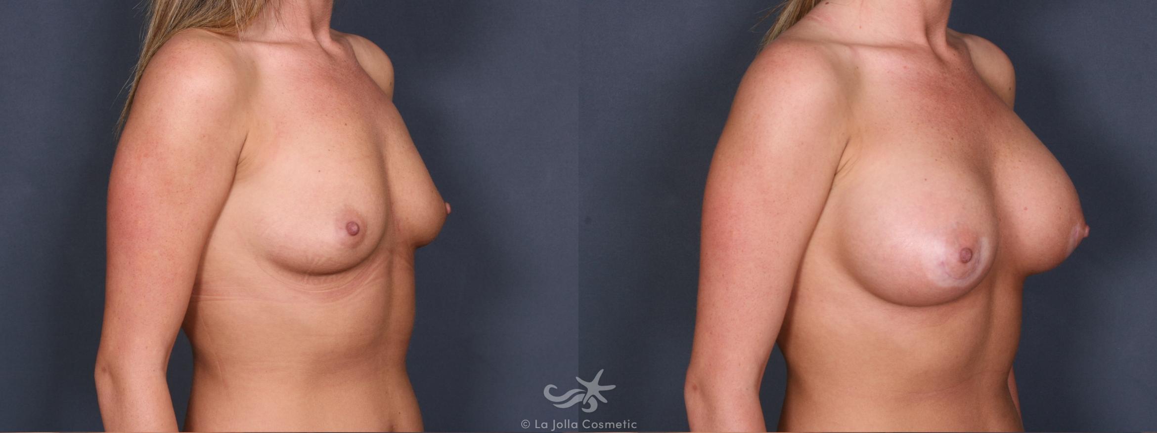 Before & After Breast Augmentation Result 396 Right Oblique View in San Diego, CA