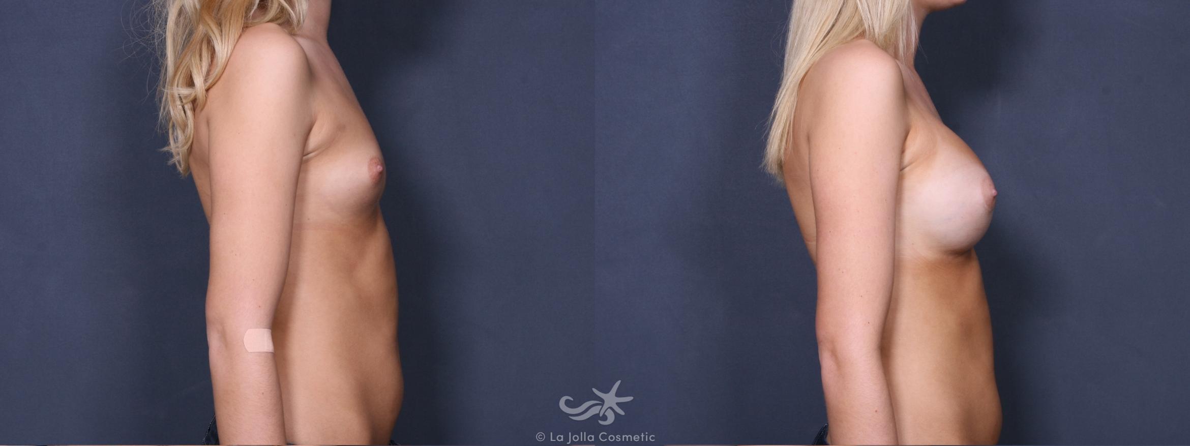 Before & After Breast Augmentation Result 400 Right Side View in San Diego, CA