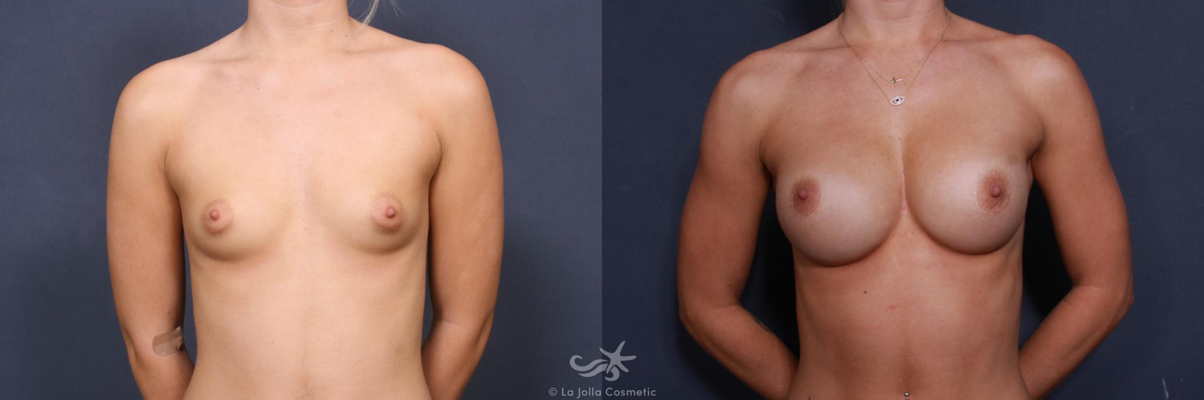 Before & After Breast Augmentation Result 403 Front View in San Diego, CA
