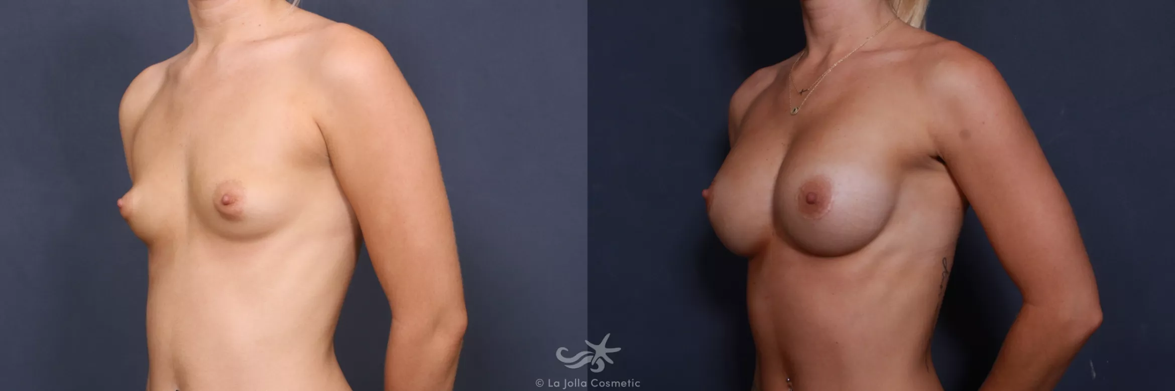 Before & After Breast Augmentation Result 403 Left Oblique View in San Diego, CA
