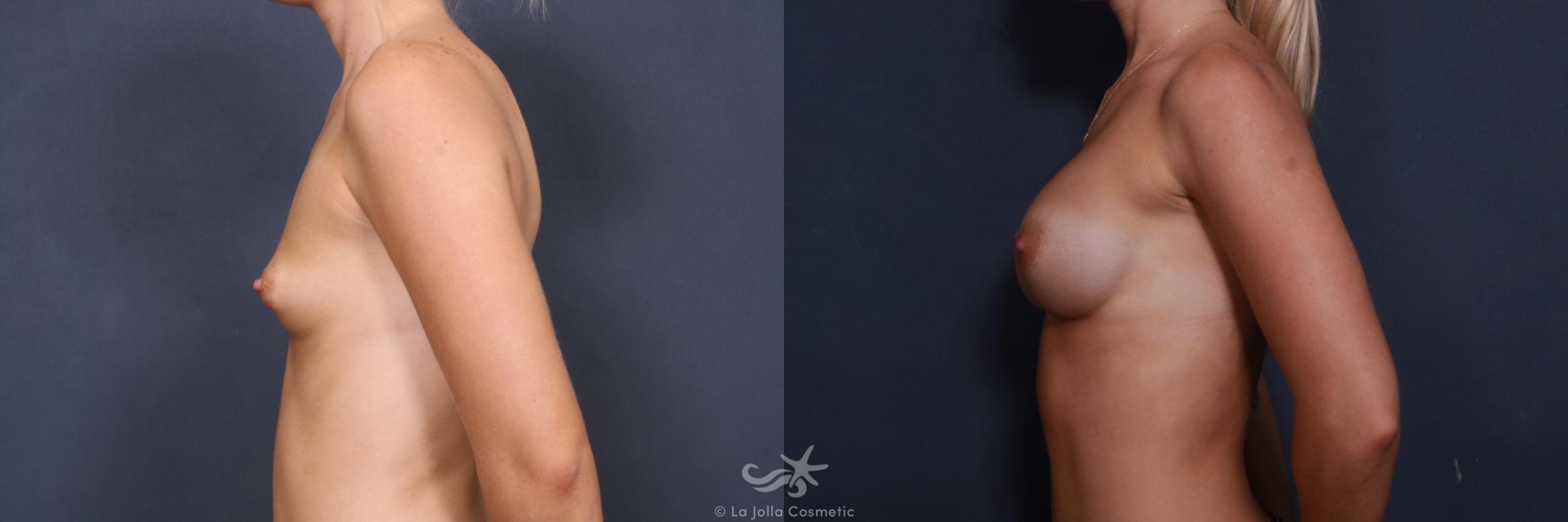 Before & After Breast Augmentation Result 403 Left Side View in San Diego, CA