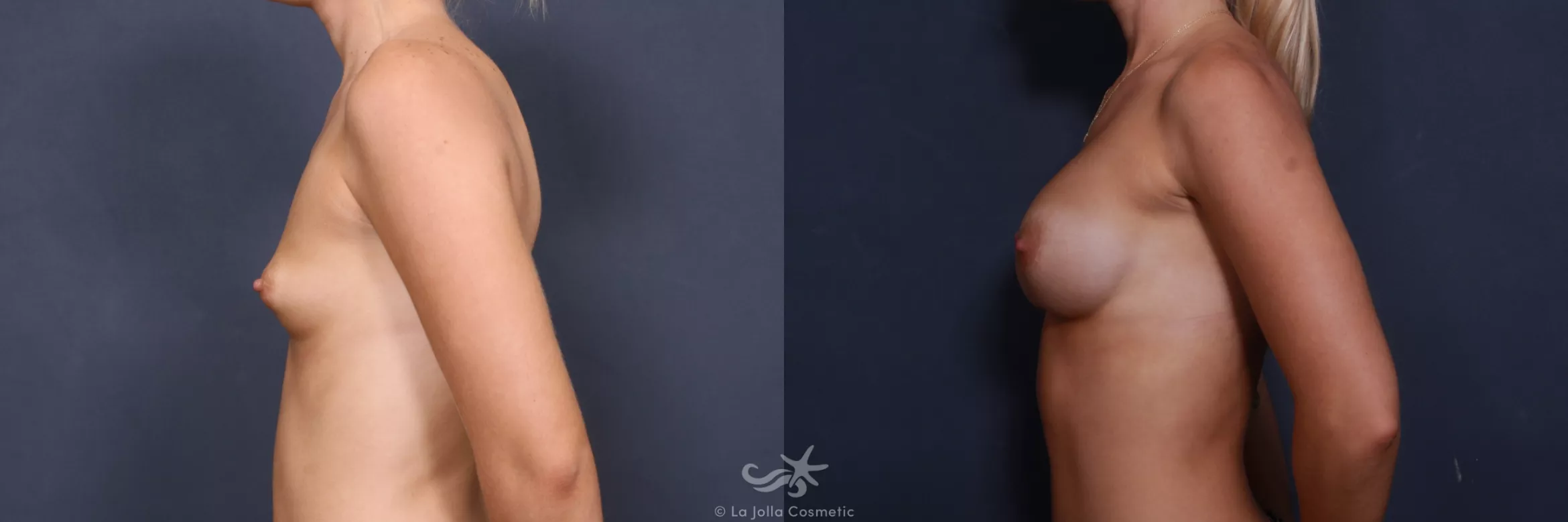 Before & After Breast Augmentation Result 403 Left Side View in San Diego, CA