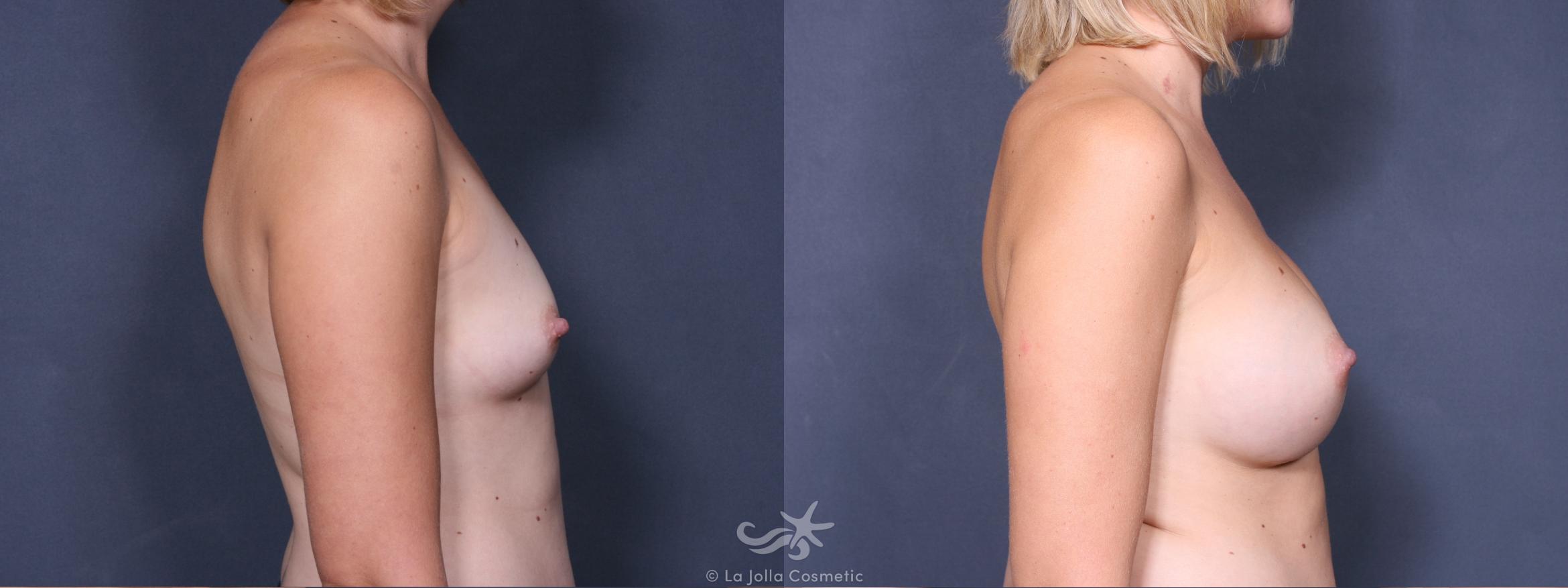 Before & After Breast Augmentation Result 406 Right Side View in San Diego, CA