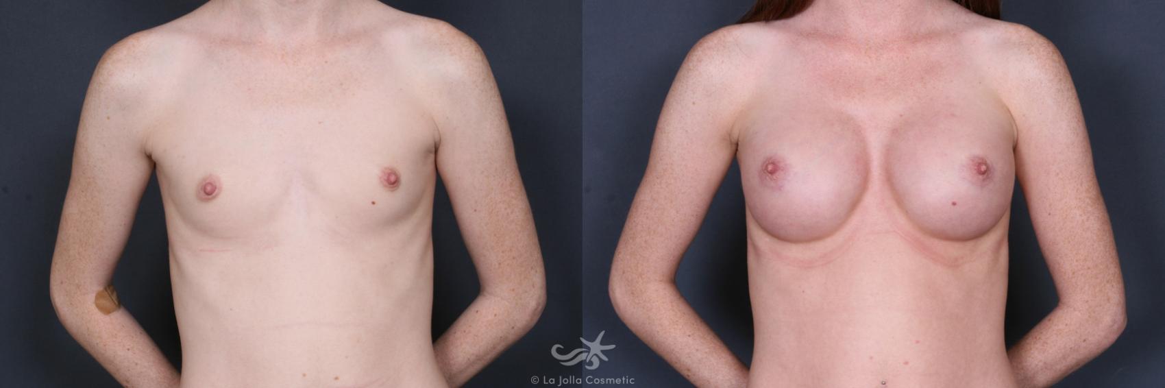 Before & After Breast Augmentation Result 408 Front View in San Diego, CA