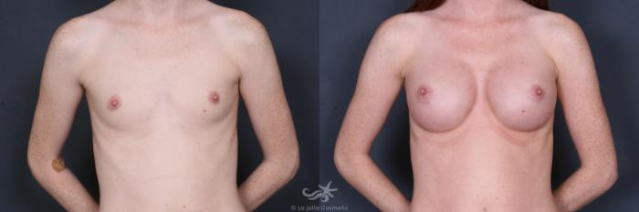 Before & After Breast Augmentation Result 408 Front View in San Diego, Carlsbad, CA