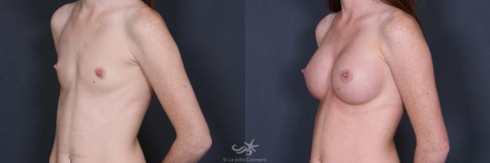 Before & After Breast Augmentation Result 408 Left Oblique View in San Diego, Carlsbad, CA