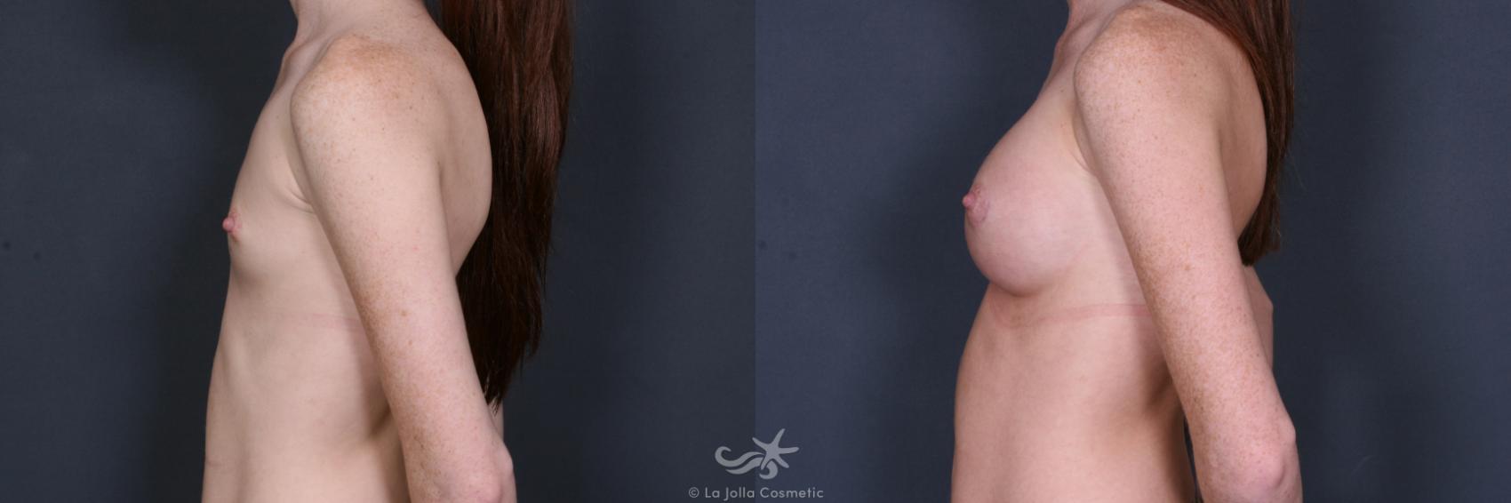 Before & After Breast Augmentation Result 408 Left Side View in San Diego, CA