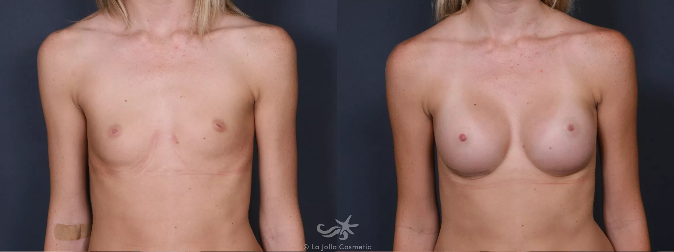 Before & After Breast Augmentation Result 409 Front View in San Diego, CA
