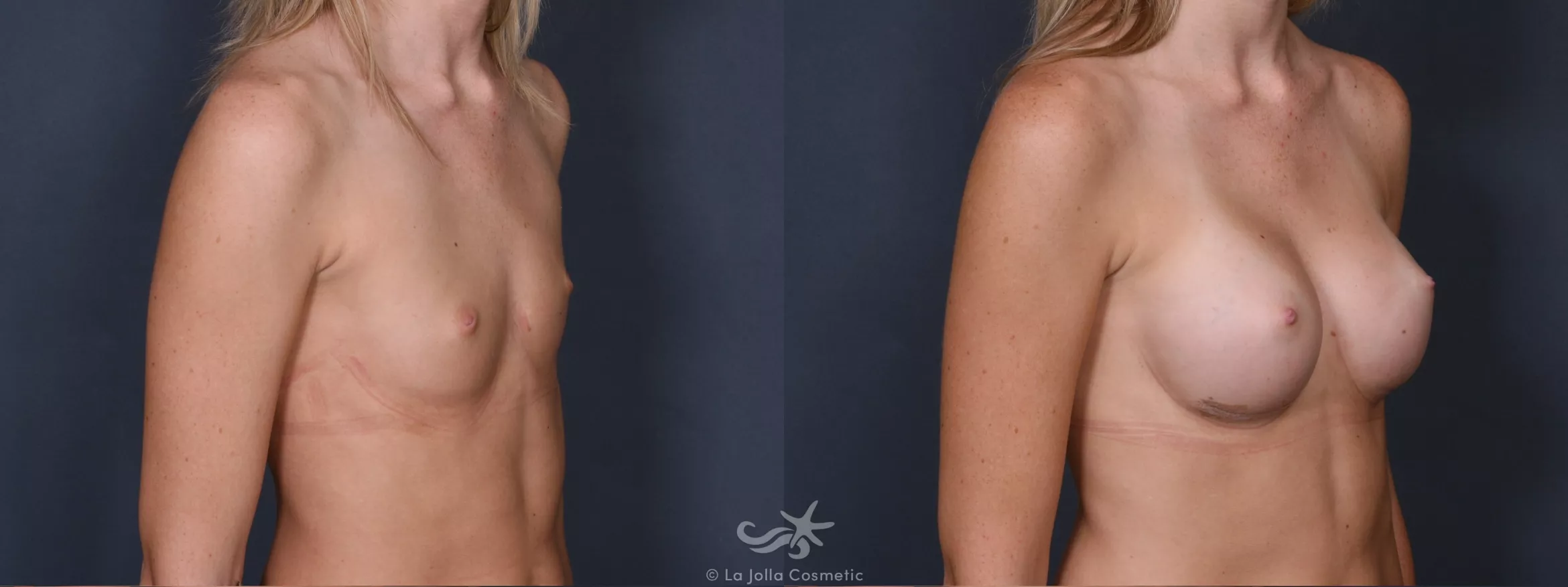Before & After Breast Augmentation Result 409 Right Oblique View in San Diego, CA