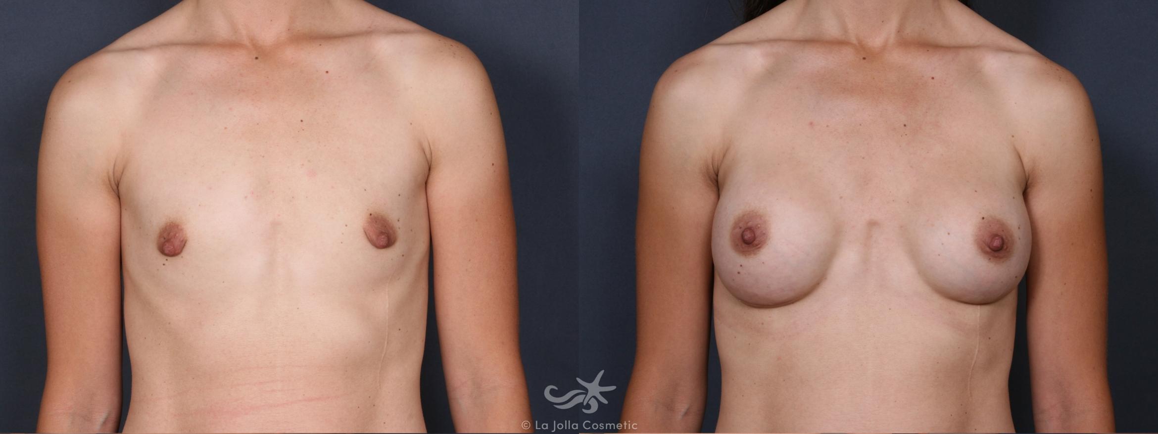 Before & After Breast Augmentation Result 410 Front View in San Diego, CA