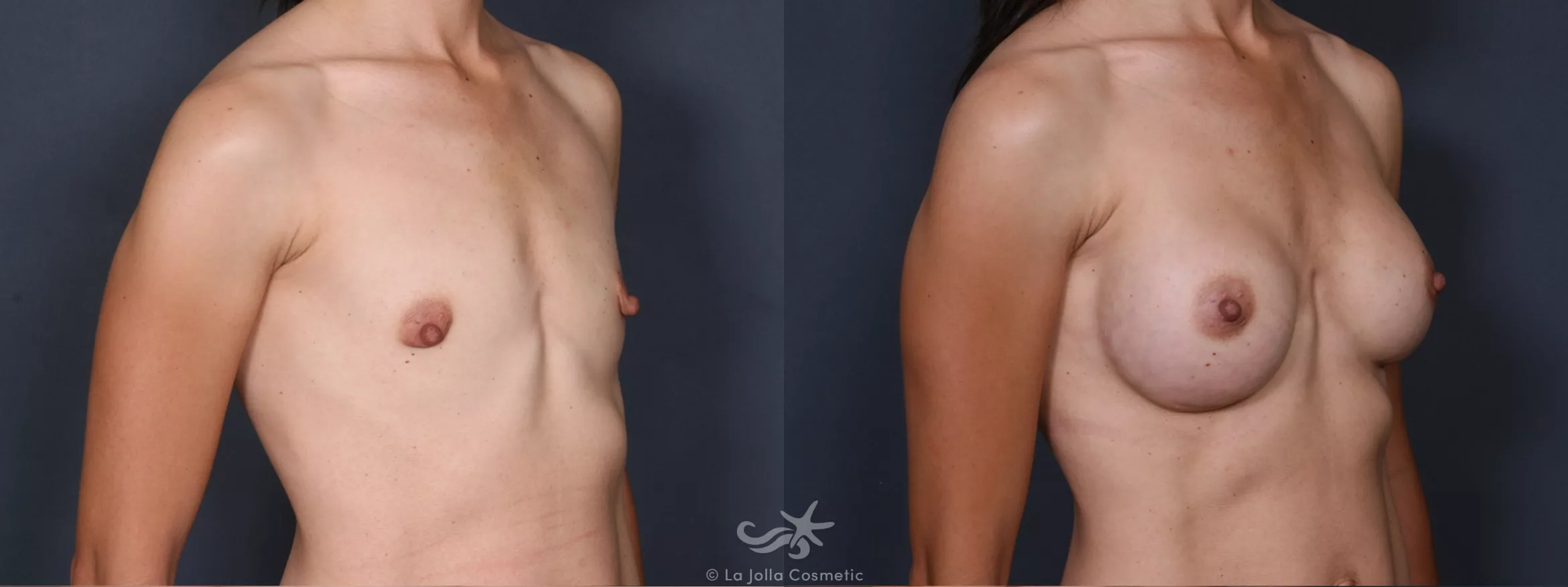 Before & After Breast Augmentation Result 410 Right Oblique View in San Diego, CA