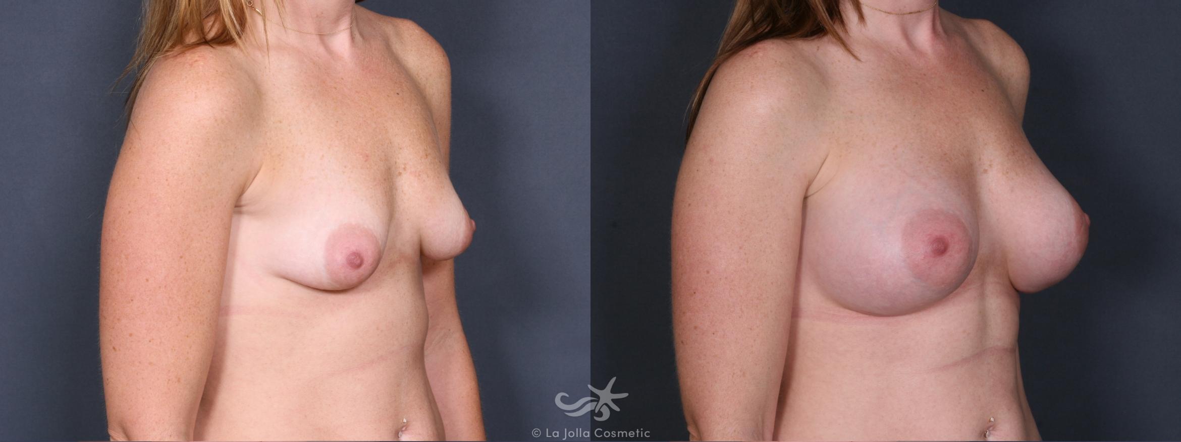 Before & After Breast Augmentation Result 412 Right Oblique View in San Diego, CA