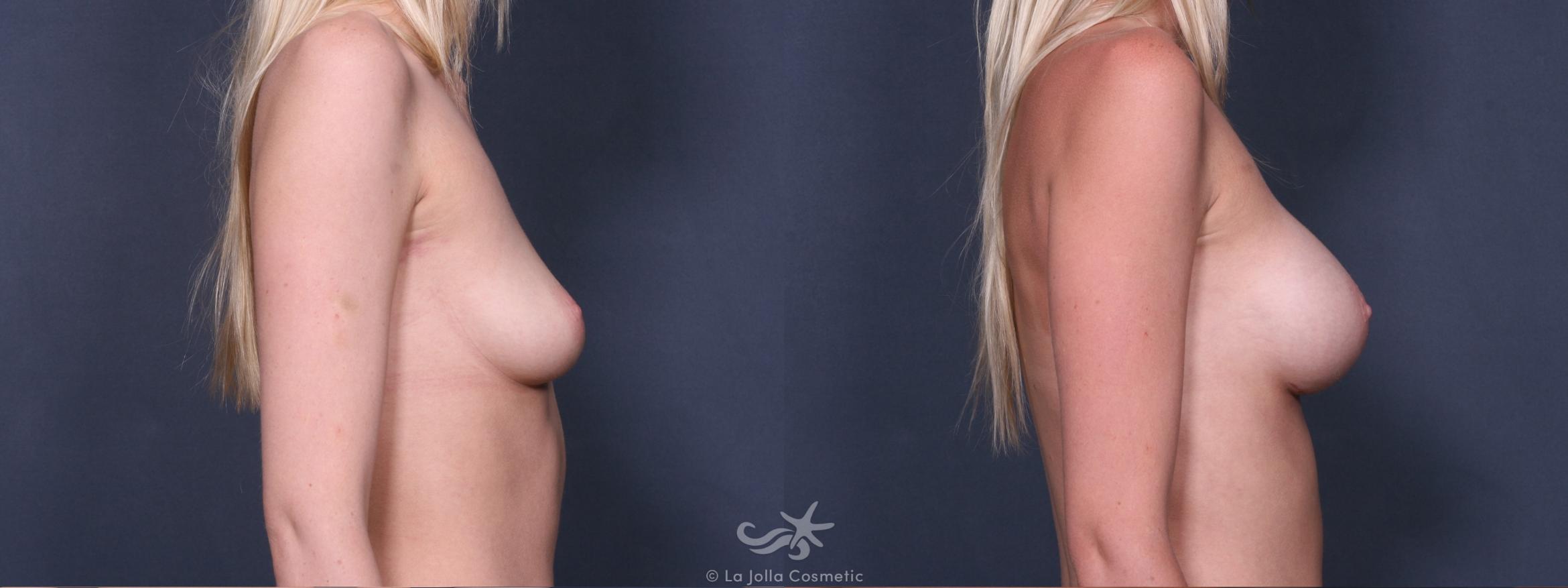 Before & After Breast Augmentation Result 414 Right Side View in San Diego, CA