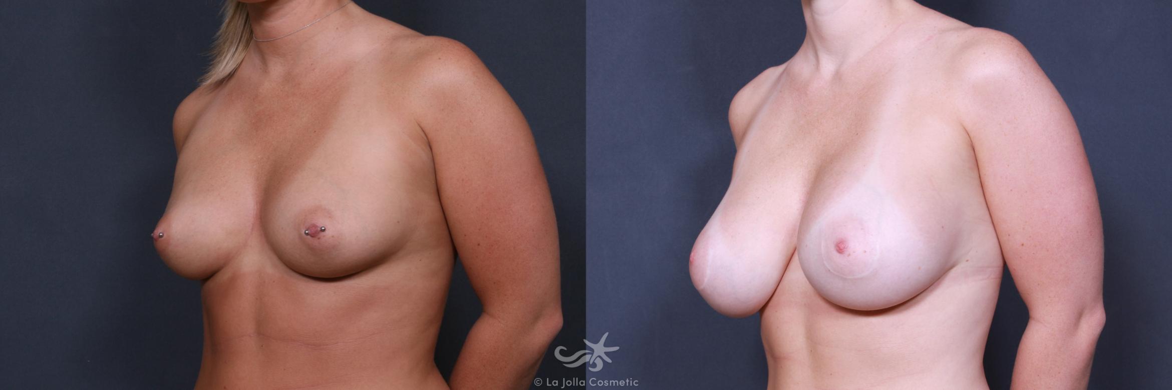 Before & After Breast Augmentation Result 415 Left Oblique View in San Diego, CA