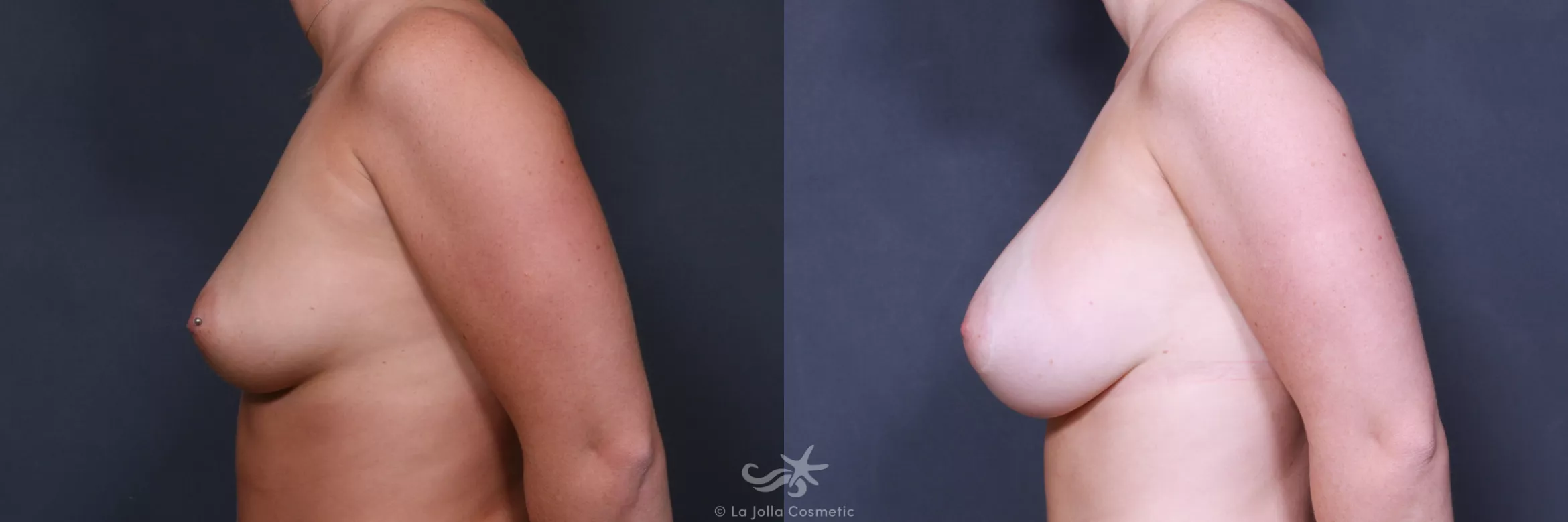 Before & After Breast Augmentation Result 415 Left Side View in San Diego, CA