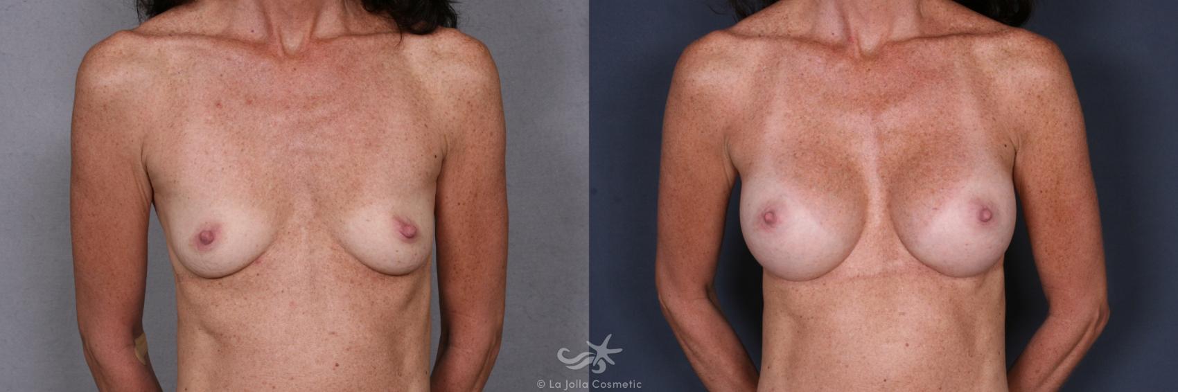 Before & After Breast Augmentation Result 416 Front View in San Diego, CA