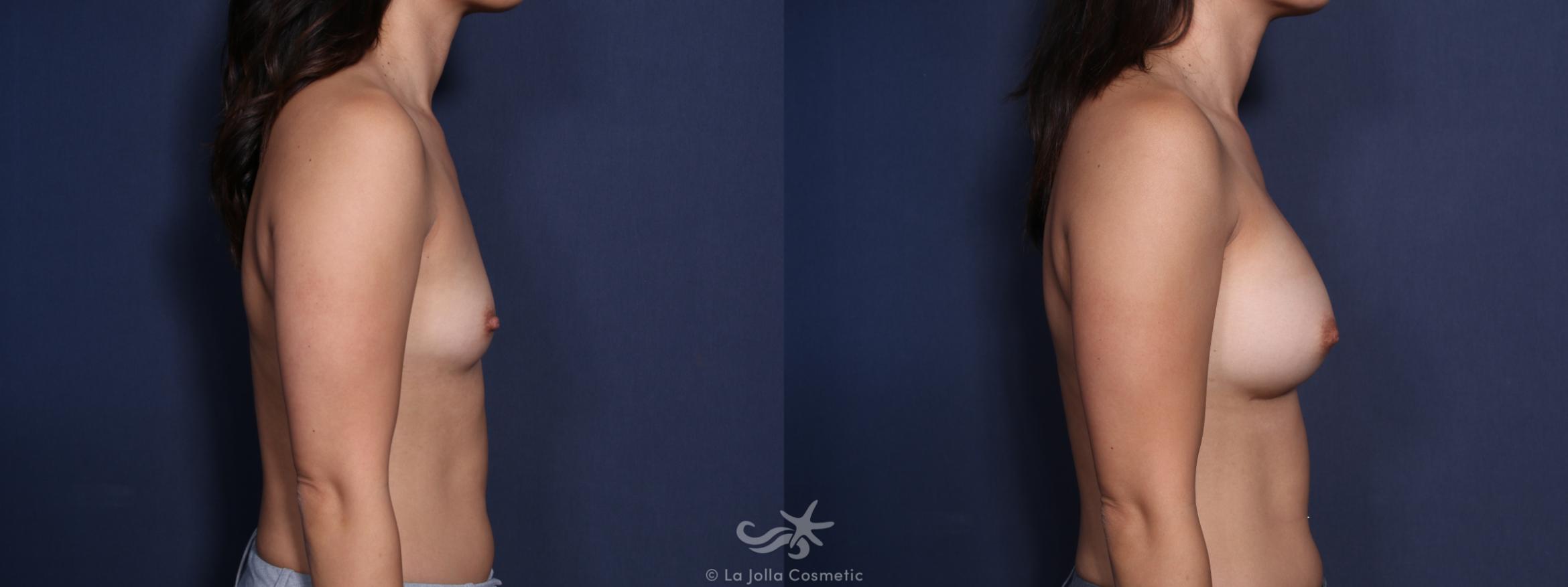 Before & After Breast Augmentation Result 42 Right Side View in San Diego, CA
