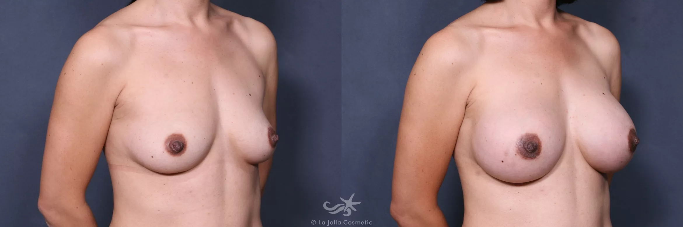 Before & After Breast Augmentation Result 421 Right Oblique View in San Diego, CA