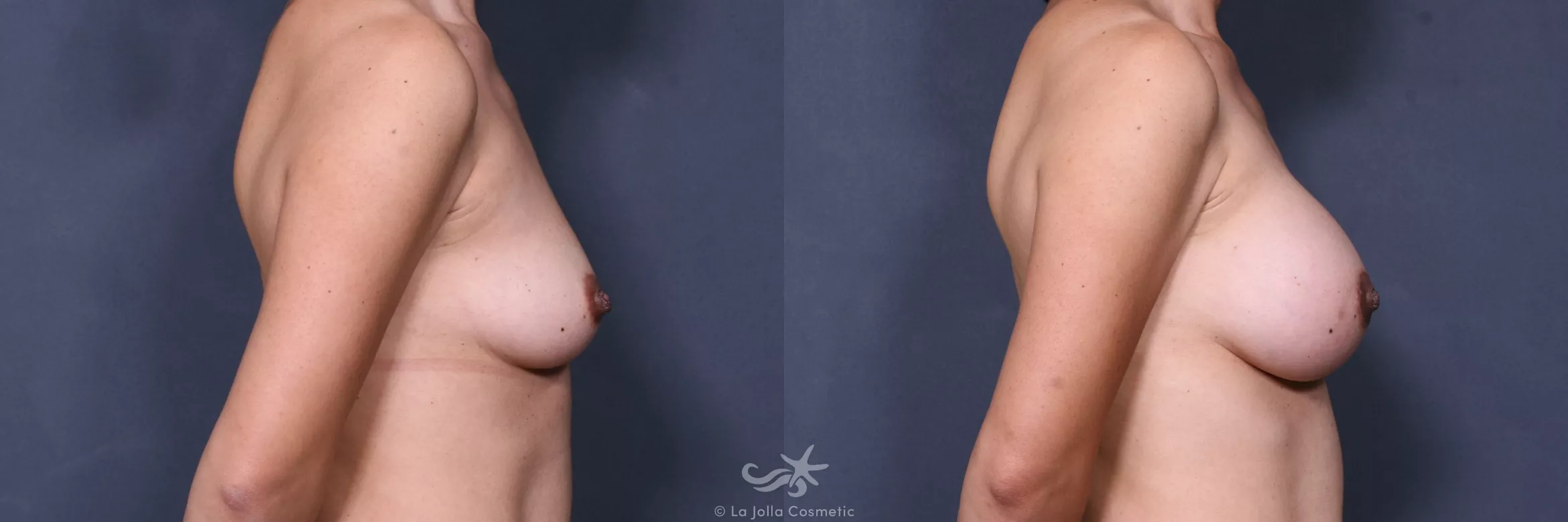 Before & After Breast Augmentation Result 421 Right Side View in San Diego, CA
