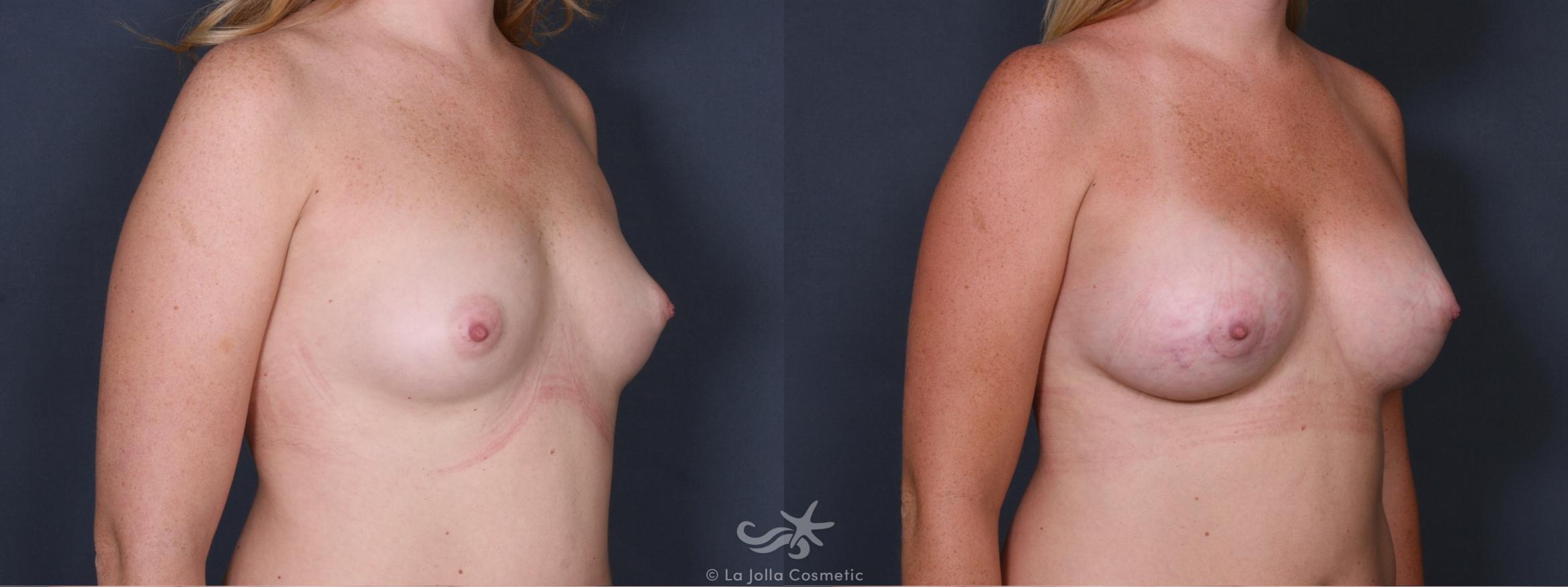 Before & After Breast Augmentation Result 422 Right Oblique View in San Diego, CA