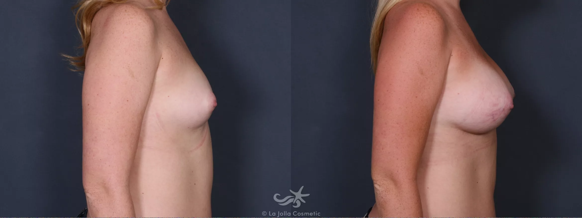 Before & After Breast Augmentation Result 422 Right Side View in San Diego, CA