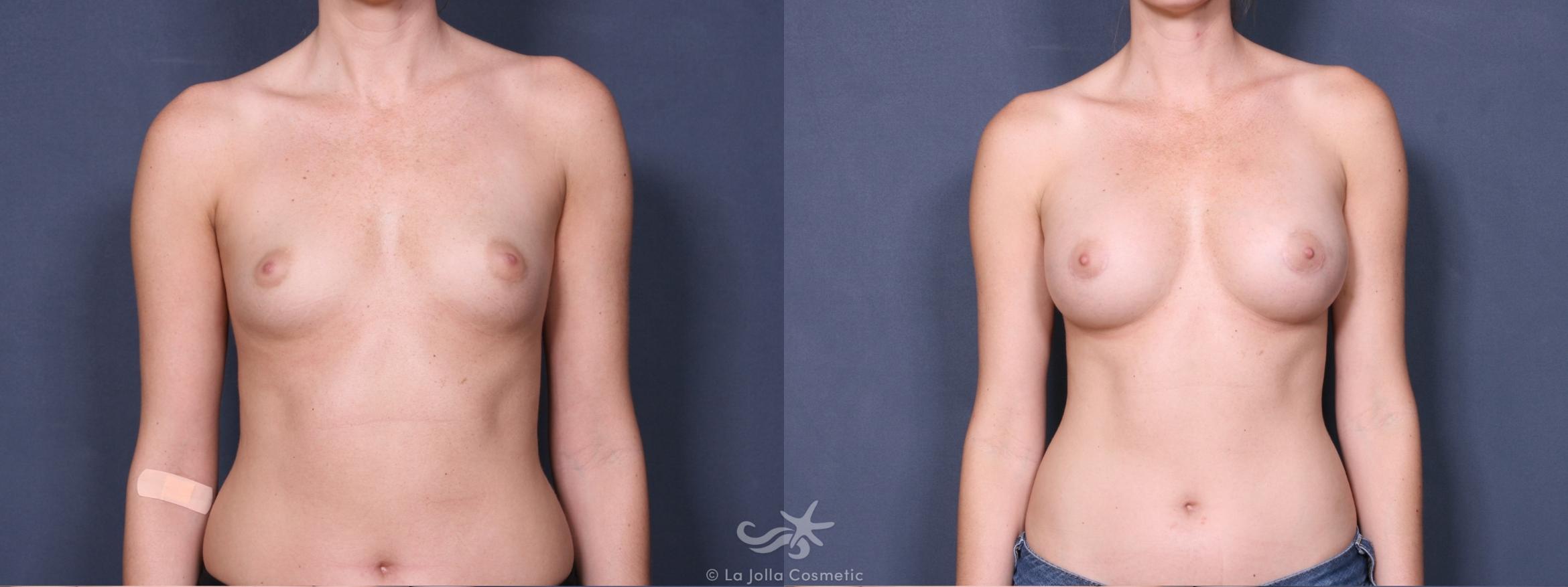 Before & After Breast Augmentation Result 427 Front View in San Diego, CA