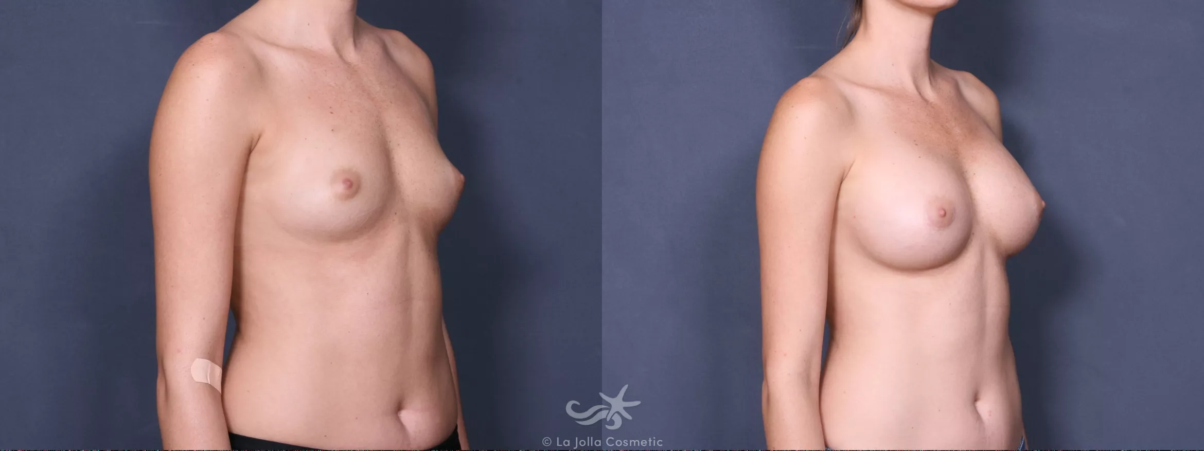 Before & After Breast Augmentation Result 427 Right Oblique View in San Diego, CA