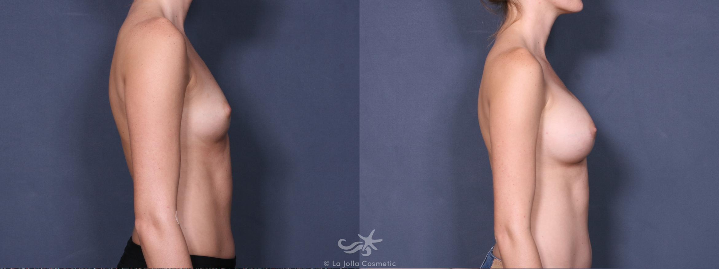 Before & After Breast Augmentation Result 427 Right Side View in San Diego, CA