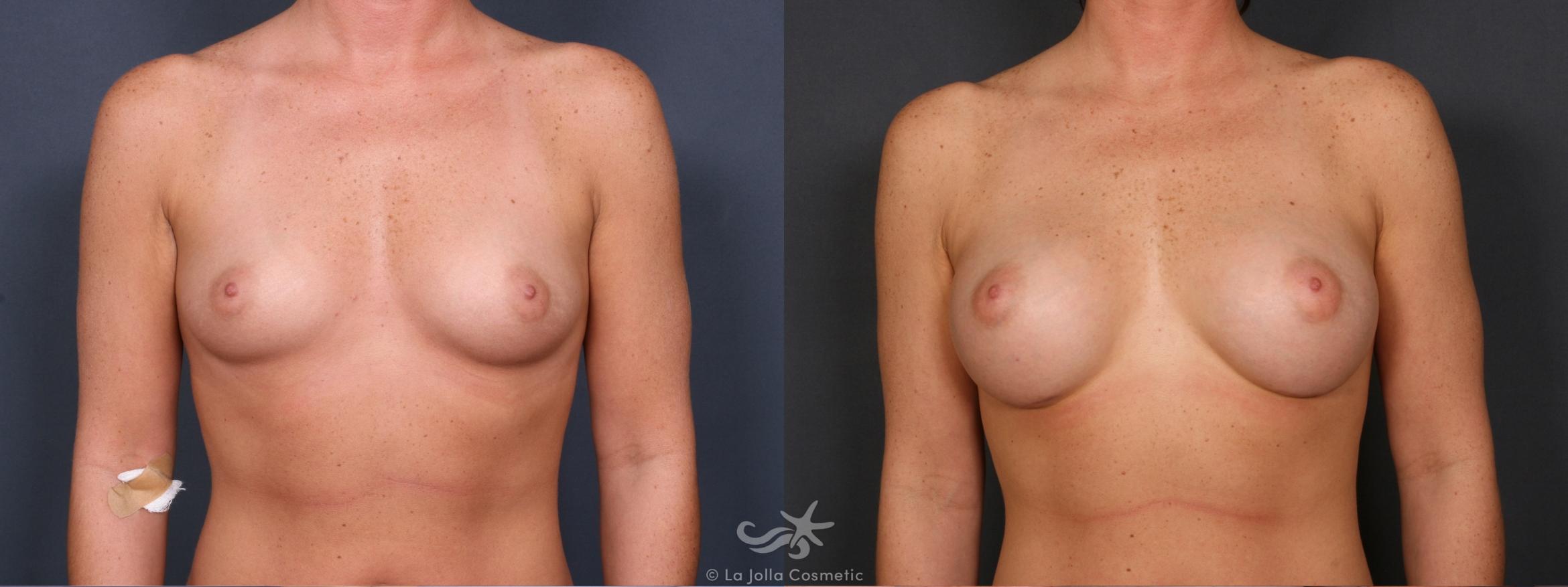 Before & After Breast Augmentation Result 428 Front View in San Diego, CA