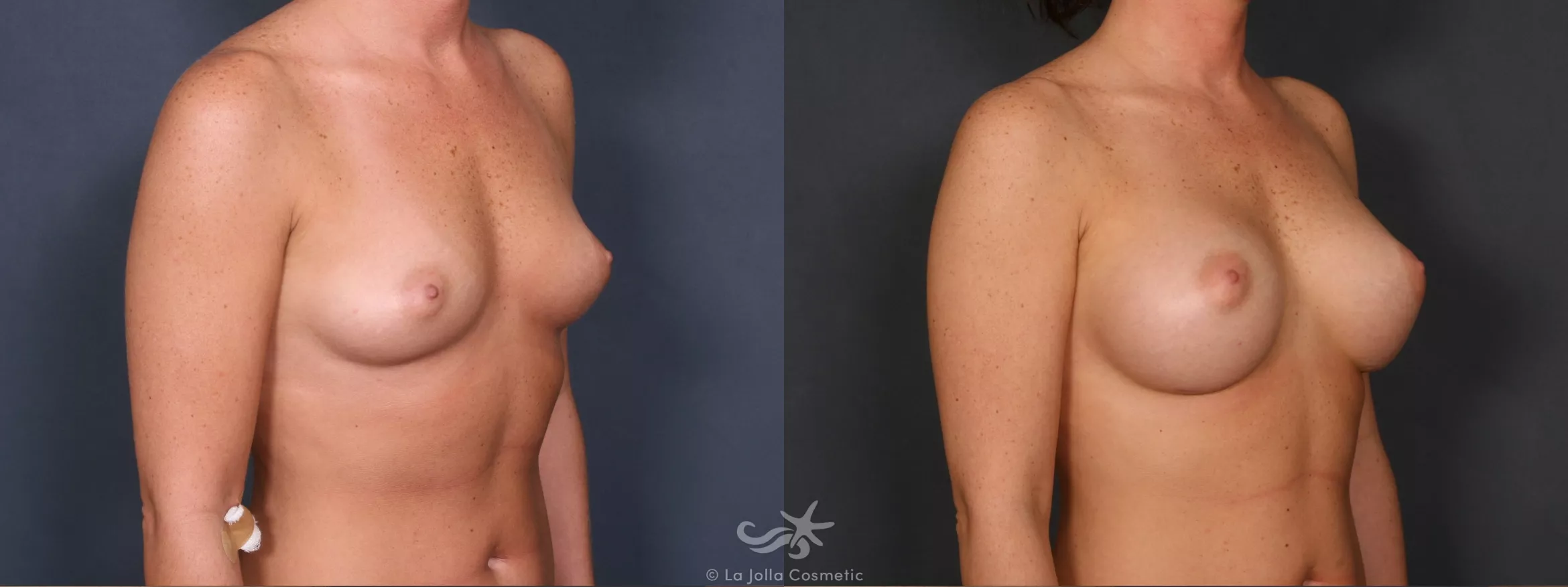 Before & After Breast Augmentation Result 428 Right Oblique View in San Diego, CA