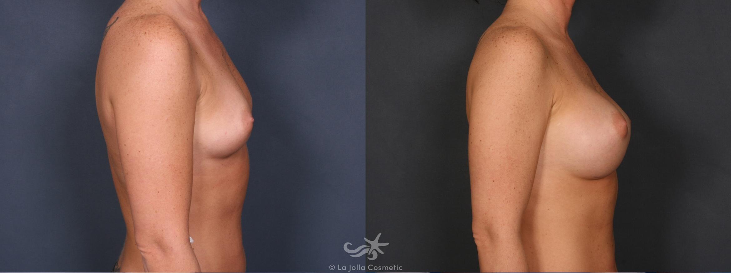 Before & After Breast Augmentation Result 428 Right Side View in San Diego, CA