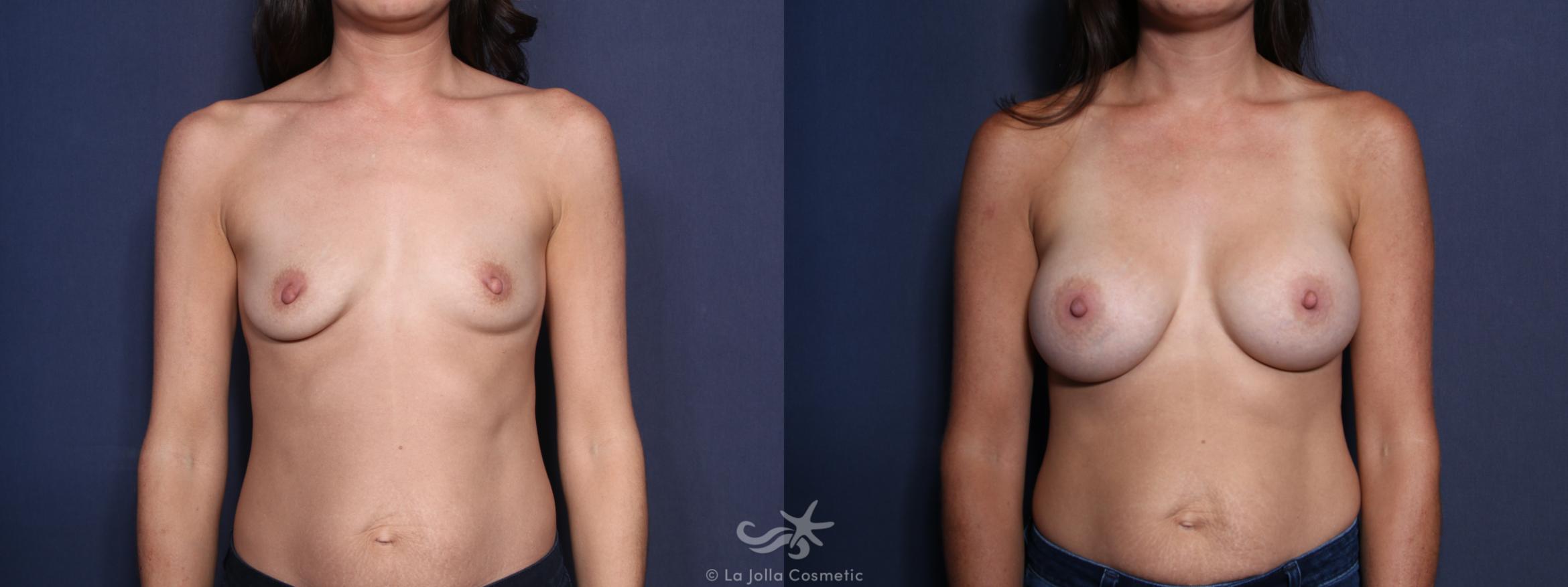 Before & After Breast Augmentation Result 43 Front View in San Diego, CA