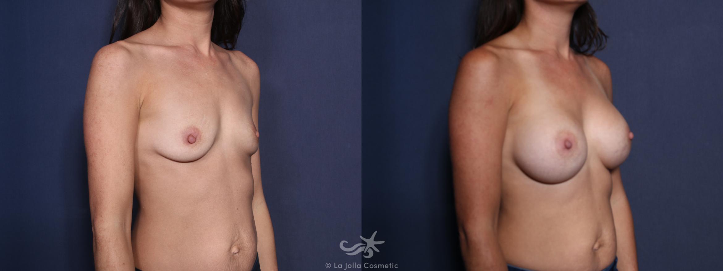 Before & After Breast Augmentation Result 43 Right Oblique View in San Diego, CA