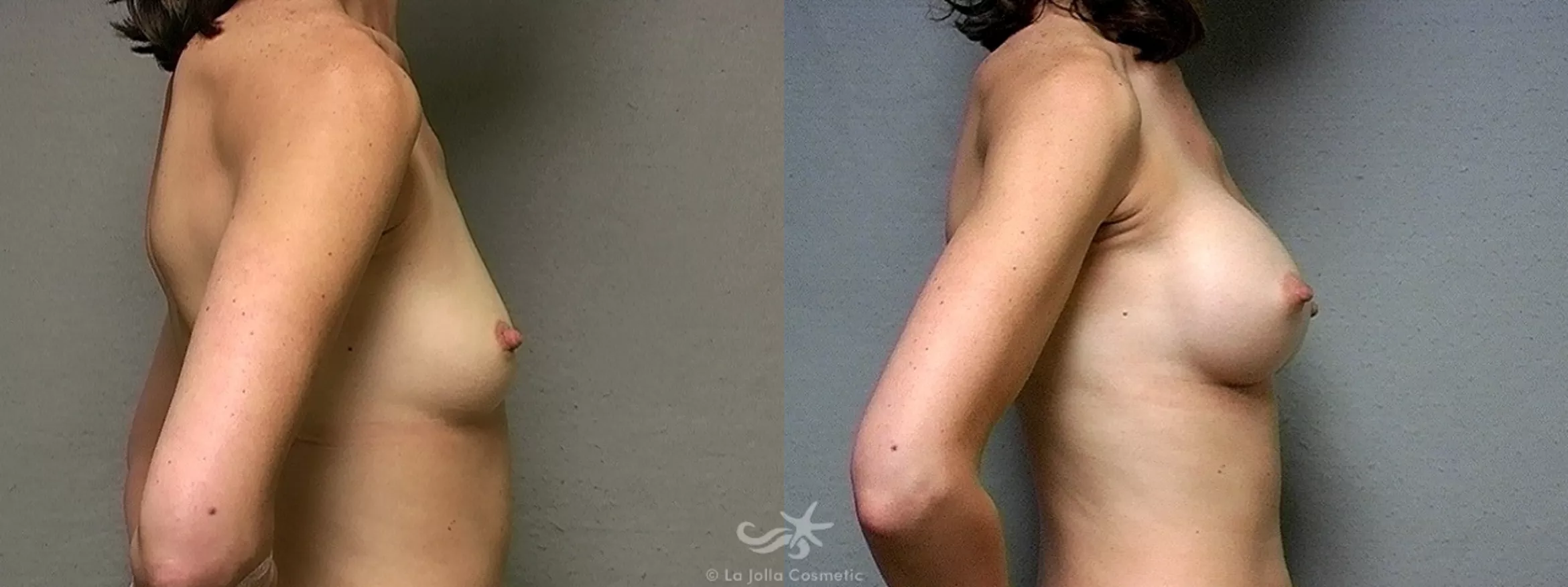 Before & After Breast Augmentation Result 432 Right Side View in San Diego, CA