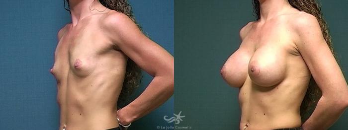 Before & After Breast Augmentation Result 434 Left Oblique View in San Diego, Carlsbad, CA