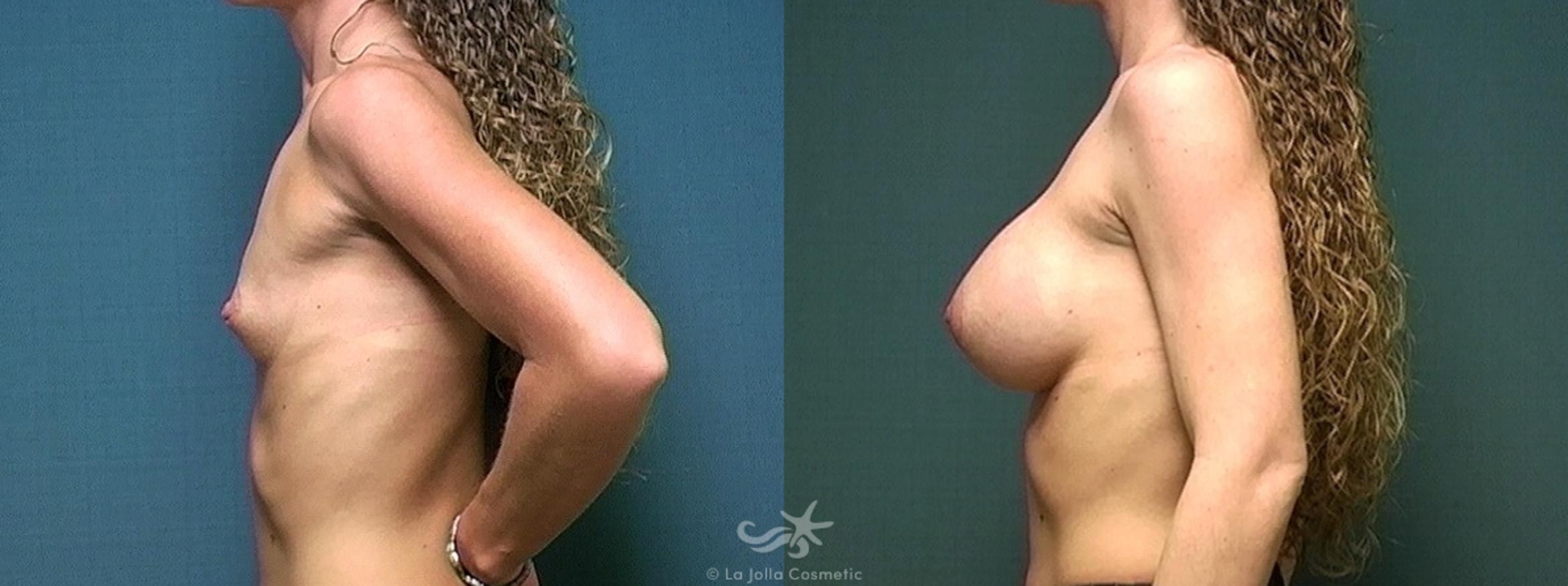 Before & After Breast Augmentation Result 434 Left Side View in San Diego, CA