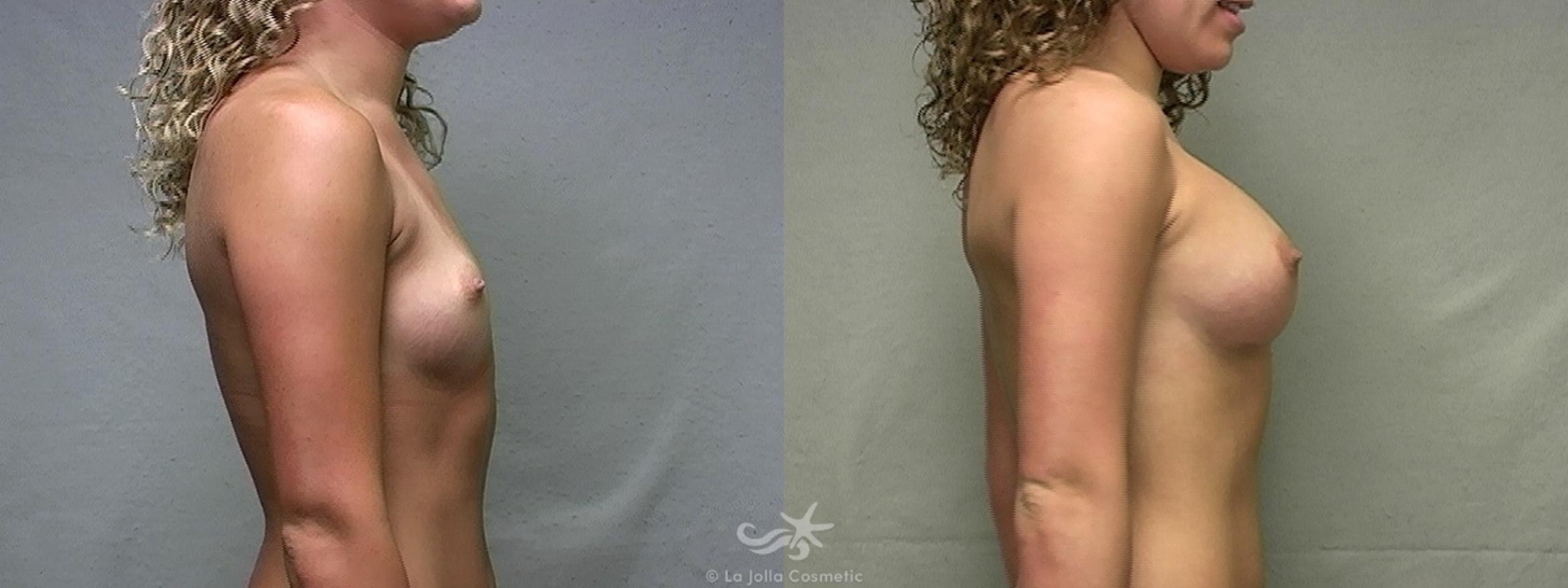 Before & After Breast Augmentation Result 435 Right Side View in San Diego, CA
