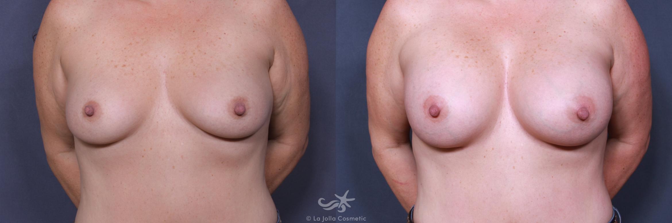 Before & After Breast Augmentation Result 437 Front View in San Diego, CA