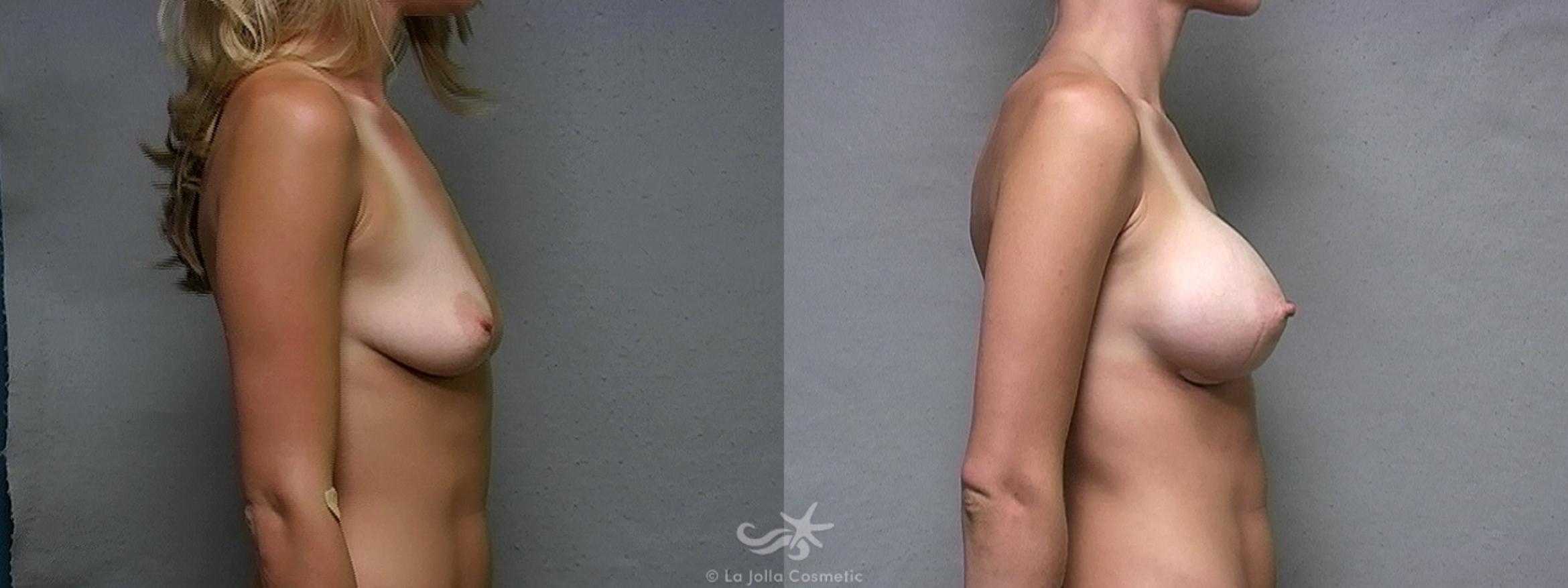 Before & After Breast Augmentation Result 439 Right Side View in San Diego, CA