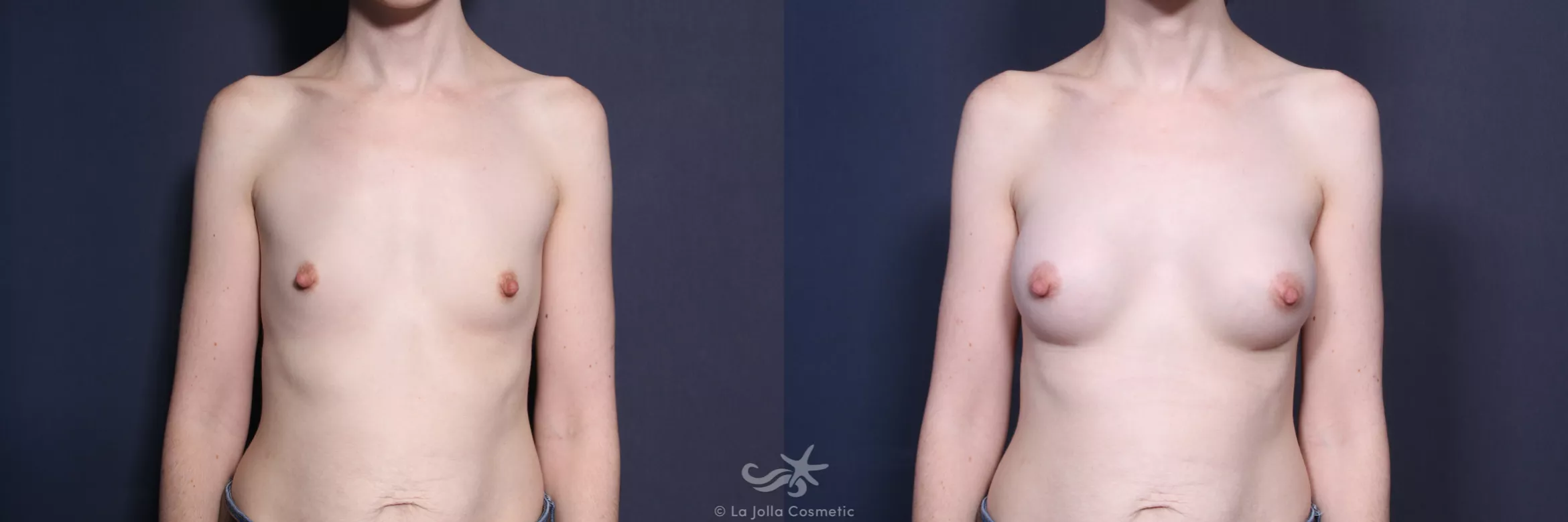 Before & After Breast Augmentation Result 440 Front View in San Diego, CA