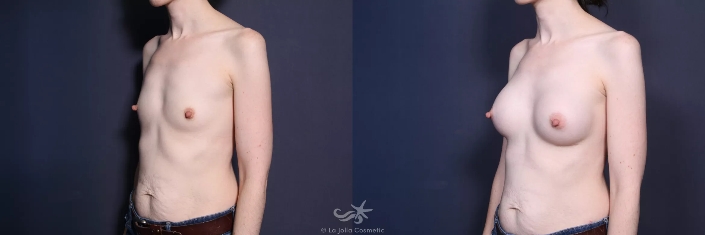 Before & After Breast Augmentation Result 440 Left Oblique View in San Diego, CA
