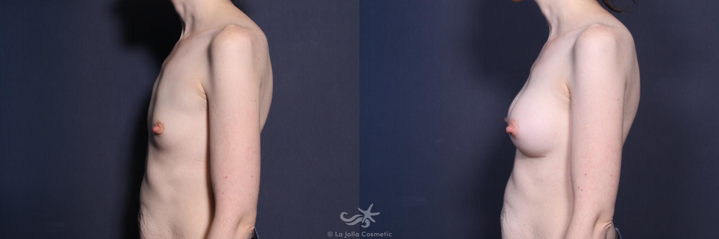 Before & After Breast Augmentation Result 440 Left Side View in San Diego, CA
