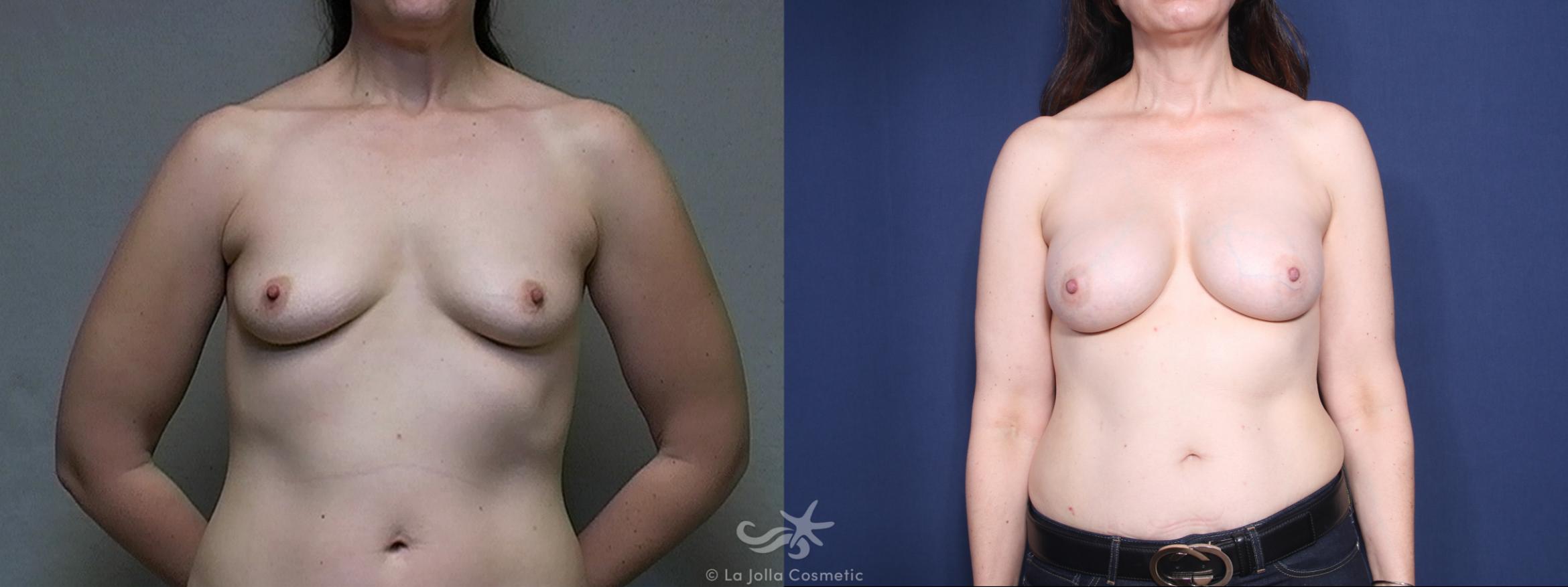 Before & After Breast Augmentation Result 441 Front View in San Diego, CA
