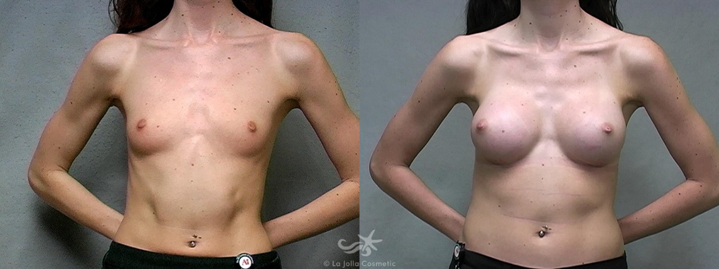 Before & After Breast Augmentation Result 442 Front View in San Diego, CA