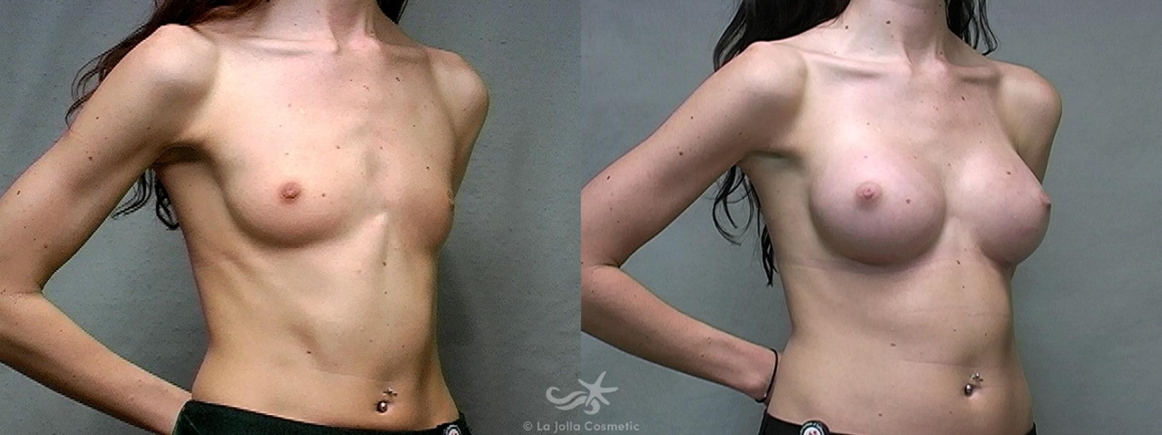Before & After Breast Augmentation Result 442 Right Oblique View in San Diego, CA