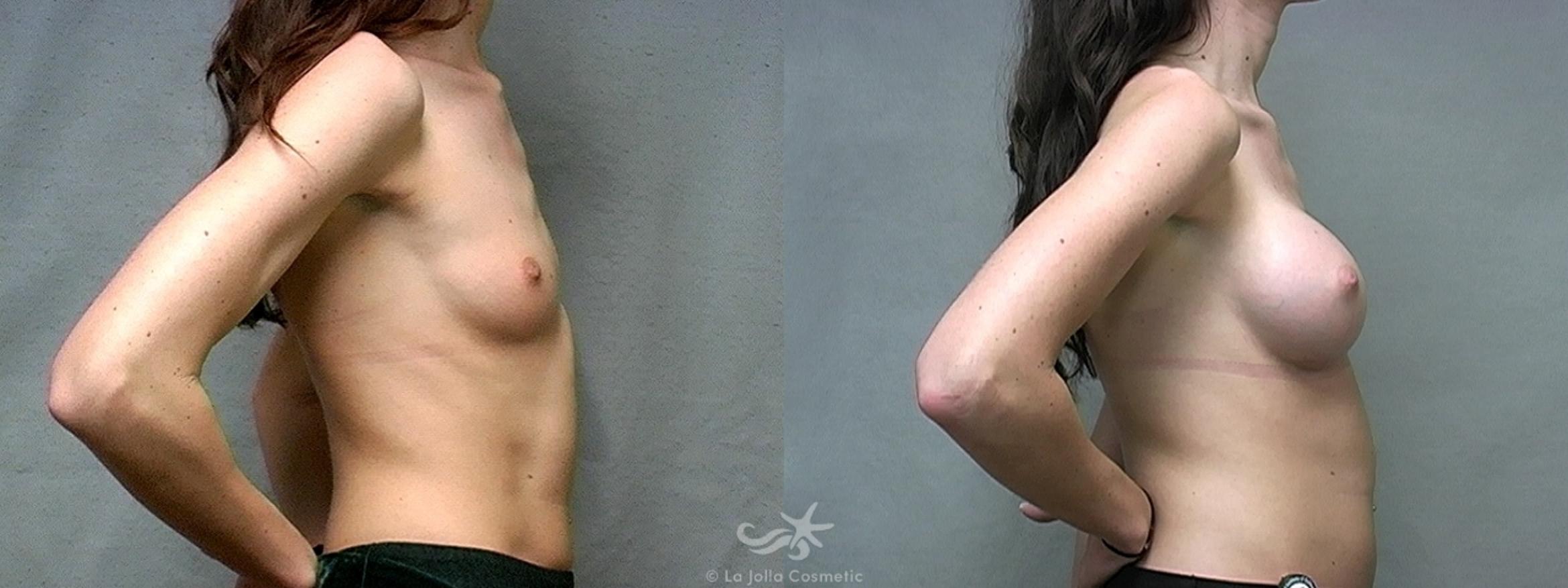 Before & After Breast Augmentation Result 442 Right Side View in San Diego, CA