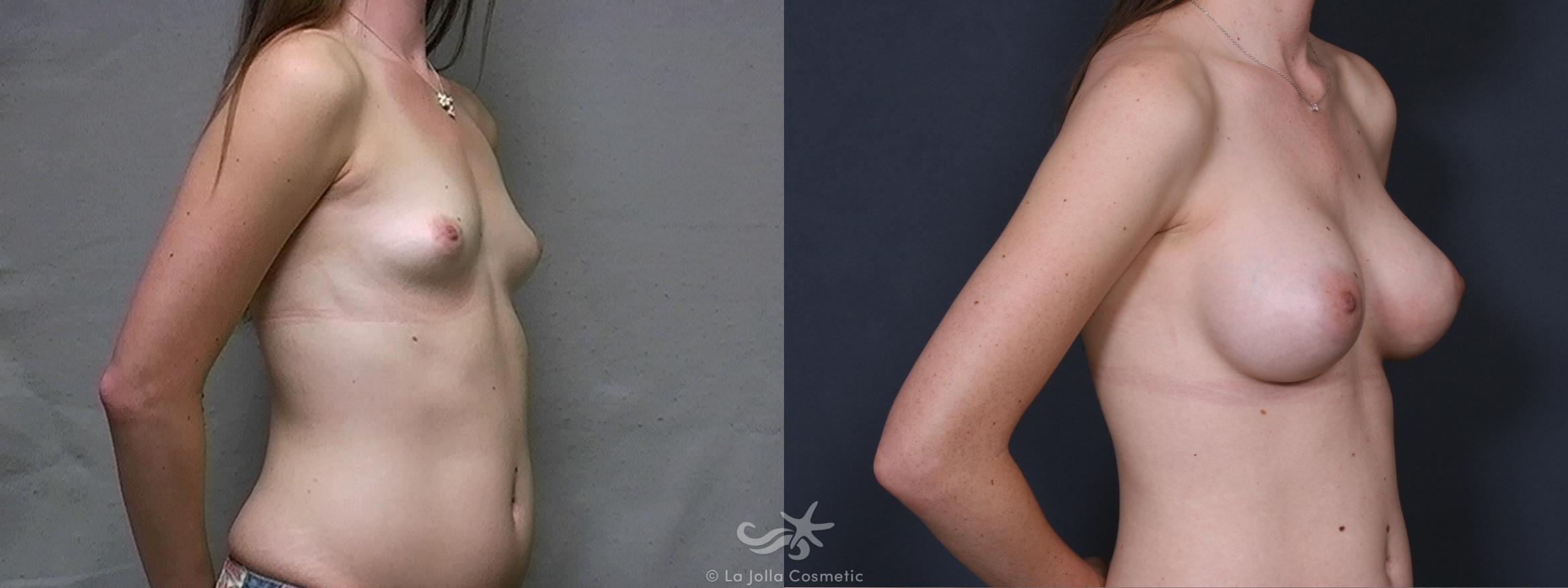 Before & After Breast Augmentation Result 443 Right Oblique View in San Diego, CA
