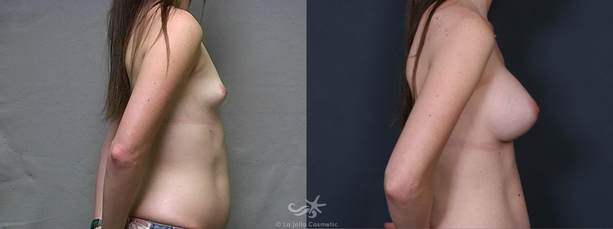 Before & After Breast Augmentation Result 443 Right Side View in San Diego, CA
